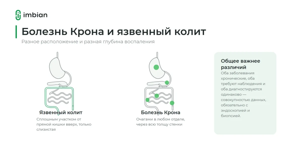 Болезнь Крона и язвенный колит: чем различается поражение кишечника