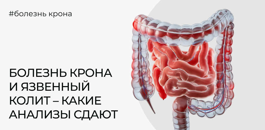 Болезнь Крона и язвенный колит: какие анализы сдают