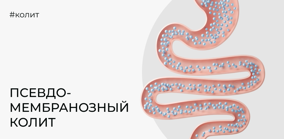 Псевдомембранозный колит: признаки и как его подтверждают